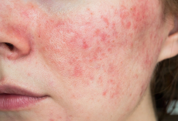 Retinol có đẩy mụn không, dấu hiệu là gì?