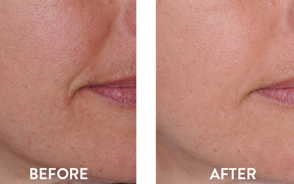 Retinol có làm mỏng da không, cách chăm sóc da khi dùng retinol