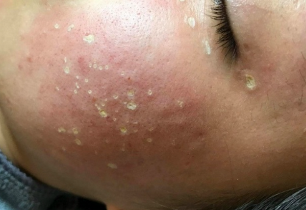 TCA 50% có nguy hiểm không? Sử dụng như thế nào an toàn?