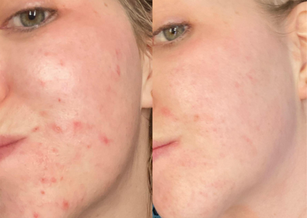 TCA 50% có nguy hiểm không? Sử dụng như thế nào an toàn?