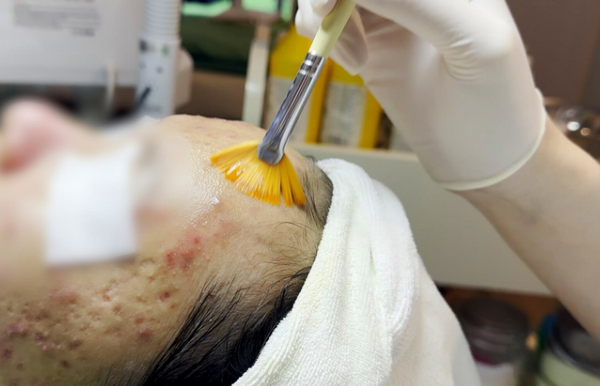 TCA 50% có nguy hiểm không? Sử dụng như thế nào an toàn?