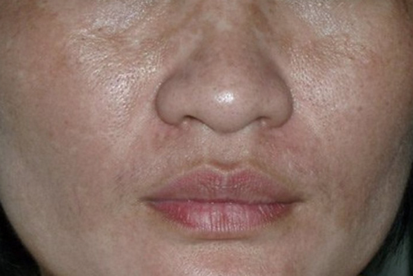 Bệnh sạm da nghề nghiệp là gì? Có điều trị được không?