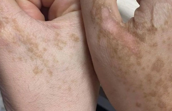 Bệnh sạm da nghề nghiệp là gì? Có điều trị được không?