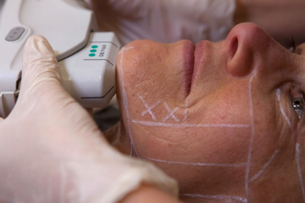 Biến chứng hifu có thể bạn chưa biết