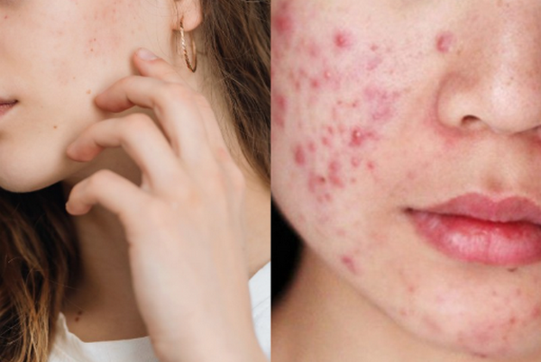 Bôi tretinoin tác dụng phụ không? Có nên dùng hàng ngày không?