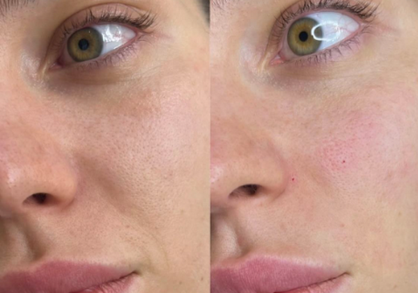 Cách xác định các điểm tiêm của Jalupro