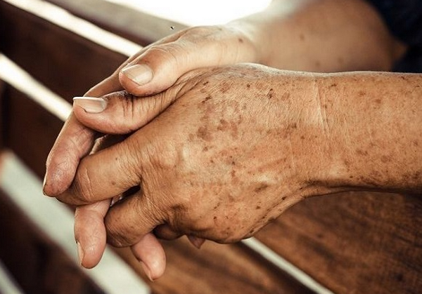 Đồi mồi ở phụ nữ và cách điều trị hiệu quả