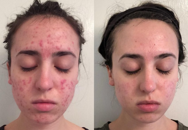 Hỏi đáp: Dùng tretinoin bao lâu có tác dụng?