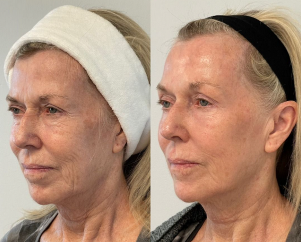 Hỏi đáp: Jalupro có phải là filler không? Thành phần của Jalupro?