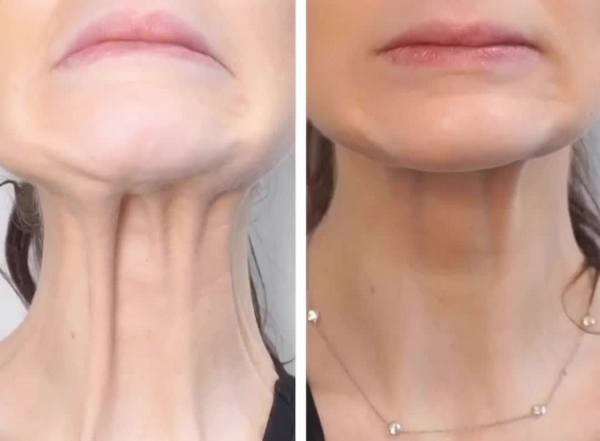 Jalupro tiêm cổ được không? Tác dụng và lưu ý quan trọng