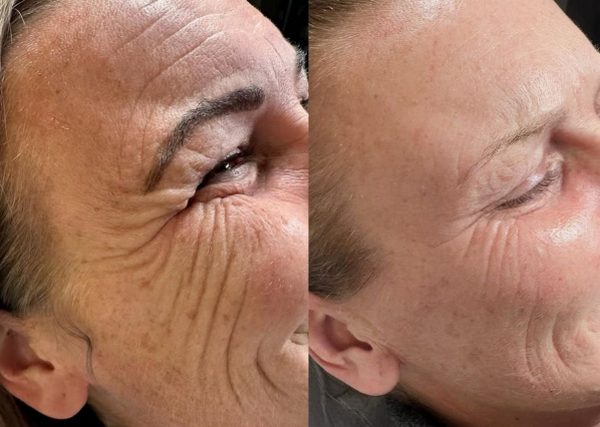 Liệu trình tiêm Jalupro Young Eye trẻ hoá mắt toàn diện