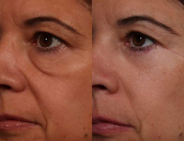 Liệu trình tiêm Jalupro Young Eye trẻ hoá mắt toàn diện