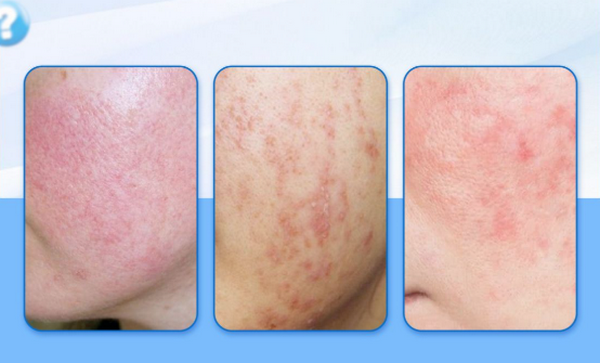 Mức độ nhiễm corticoid: 5 cấp độ kèm dấu hiệu điển hình