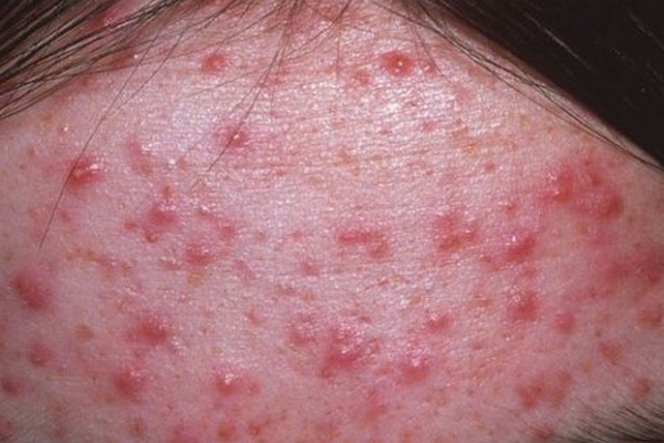 Hỏi đáp: Mụn dậy thì có những thể nào, có tự hết không?