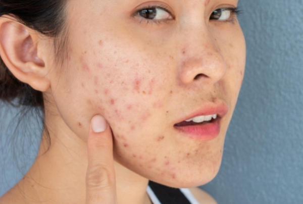 Hỏi đáp: Mụn dậy thì có những thể nào, có tự hết không?