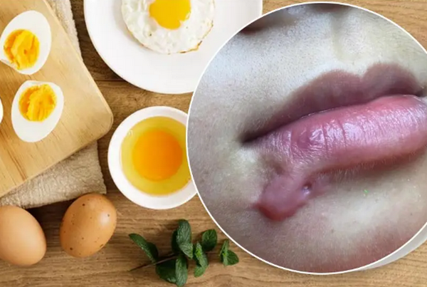 Những thực phẩm gây sẹo lồi không phải ai cũng biết