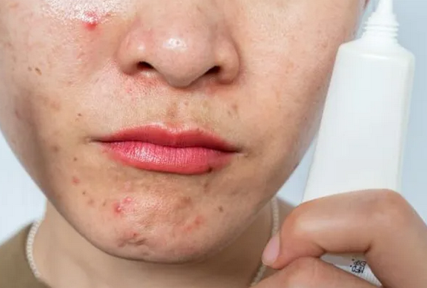 Retinol trị mụn được không? Cách dùng hiệu quả