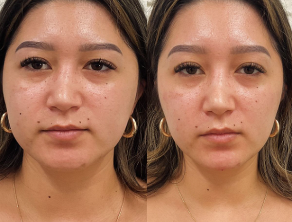 Thon gọn hàm không phẫu thuật bằng botox