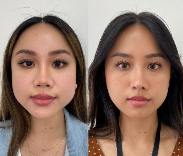 Thon gọn hàm không phẫu thuật bằng botox