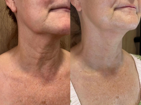 Tiêm BAP bao lâu tiêm lại?