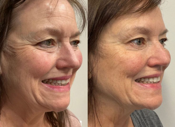 Tiêm BAP bao lâu tiêm lại?