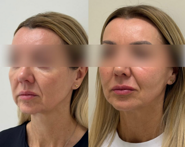 Tiêm BAP Jalupro và Profhilo cái nào tốt hơn