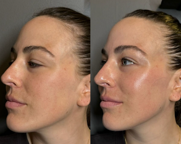 Tiêm Jalupro Super Hydro là gì? Giá bao nhiêu tiền