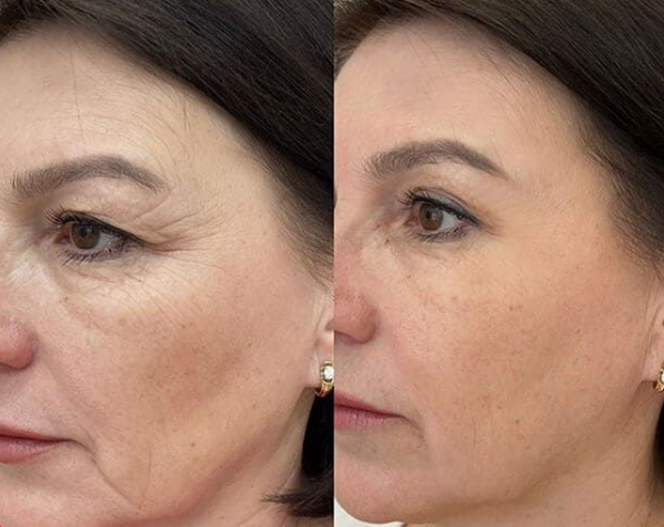 Tiêm vi điểm trên mặt là gì? Tác dụng như thế nào?