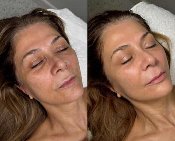 Tiêm vi điểm trên mặt là gì? Tác dụng như thế nào?