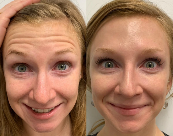 Tiêm vi điểm trên mặt là gì? Tác dụng như thế nào?