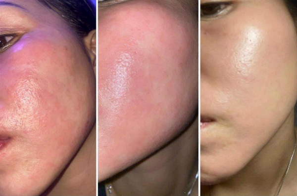 Tretinoin và retinol khác nhau như thế nào