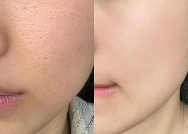 Tretinoin và retinol khác nhau như thế nào