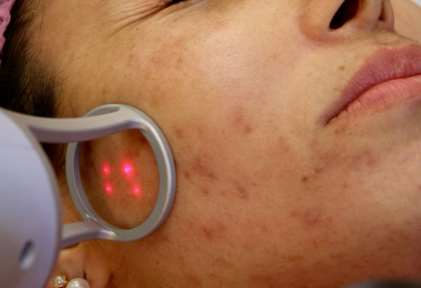 Trị sẹo thâm bằng laser giá bao nhiêu?