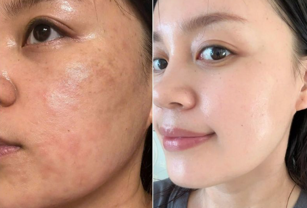 Trị sẹo thâm bằng laser giá bao nhiêu?