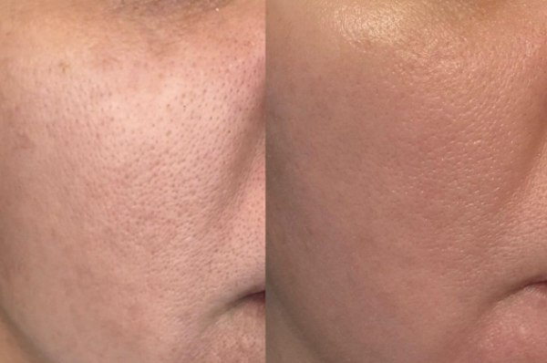 Ai nên tiêm meso, ai không nên tiêm meso?