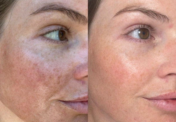 Ai nên tiêm meso, ai không nên tiêm meso?