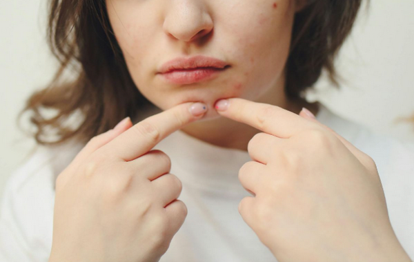 Hỏi đáp: Ăn cay nổi mụn có đúng không? 