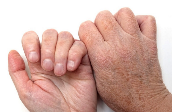 Cách trị lão hóa da tay siêu hiệu quả