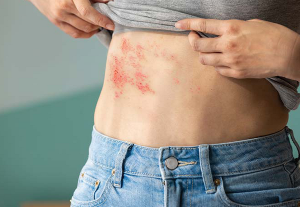 Có nên chọc mụn nước zona không? Hướng dẫn điều trị an toàn