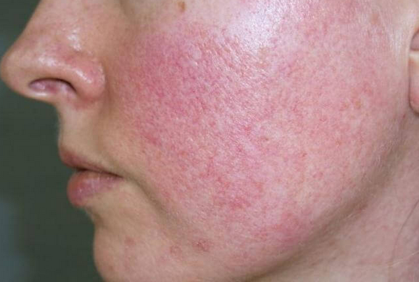 Corticoid điều trị mụn viêm: Cơ chế, tác dụng và liệu trình