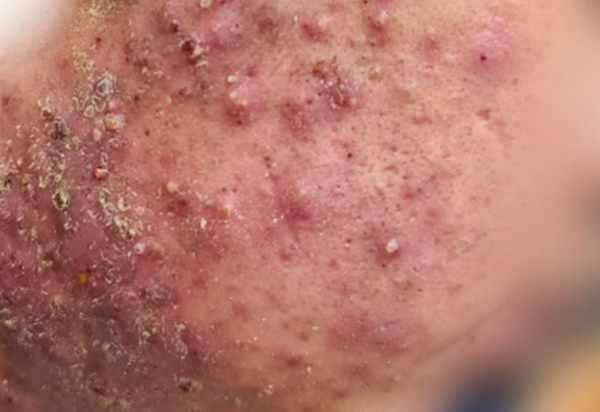 Corticoid điều trị mụn viêm: Cơ chế, tác dụng và liệu trình