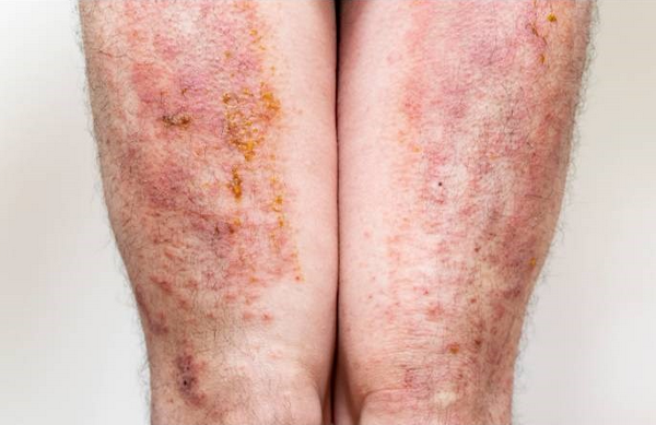 Da bị nhiễm trùng: Nguyên nhân, dấu hiệu và cách điều trị