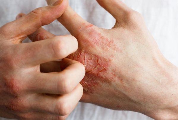 Da bị nhiễm trùng: Nguyên nhân, dấu hiệu và cách điều trị