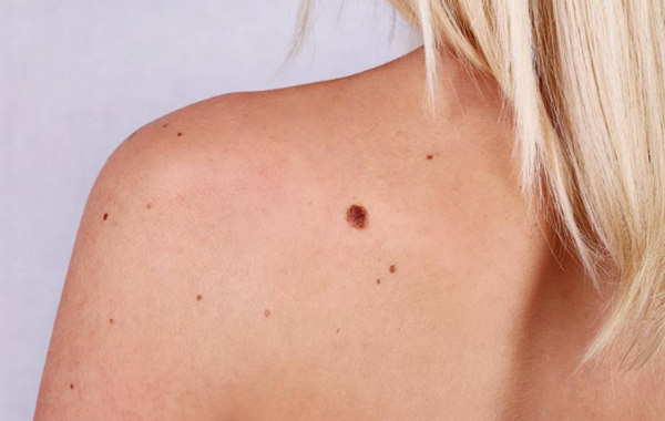 Hỏi đáp: Cháy nắng và ung thư da có liên quan như thế nào?