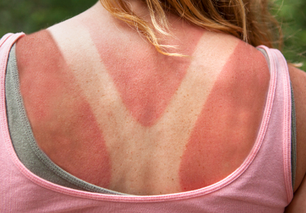 Hỏi đáp: Cháy nắng và ung thư da có liên quan như thế nào?