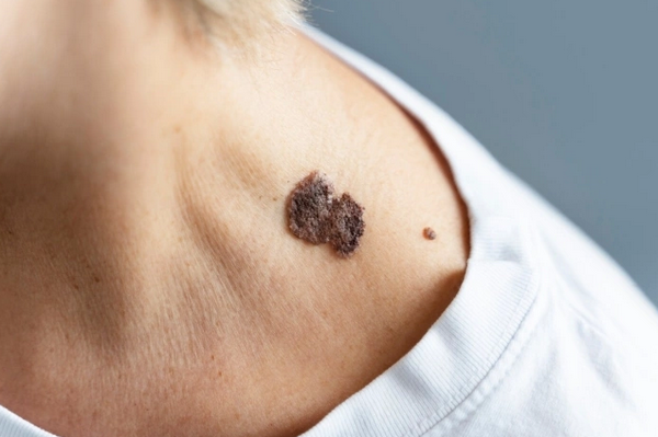 Hỏi đáp: Cháy nắng và ung thư da có liên quan như thế nào?