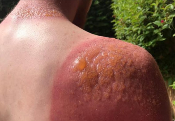 Hỏi đáp: Cháy nắng và ung thư da có liên quan như thế nào?