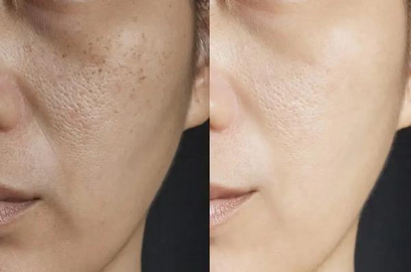 Hỏi đáp: Nên peel da hay tiêm meso?