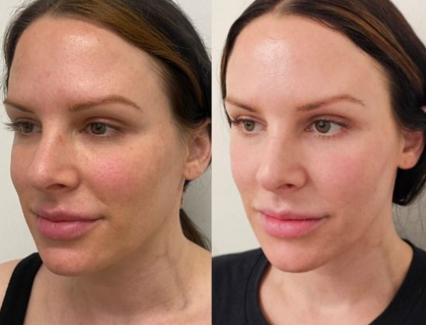 Jalupro HMW: Thành phần, chỉ định, ưu và nhược điểm