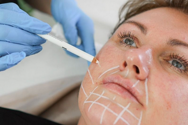 Kỹ thuật tiêm trẻ hoá dây chằng với tinh chất Jalupro